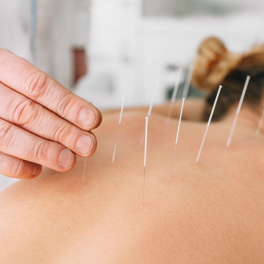 acupuncture needles in back